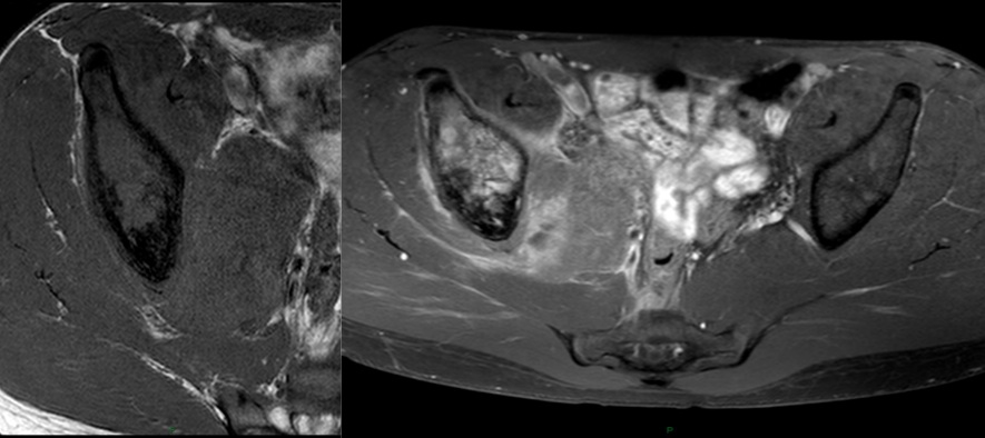 Figure 4 for case Ewing Sarcoma